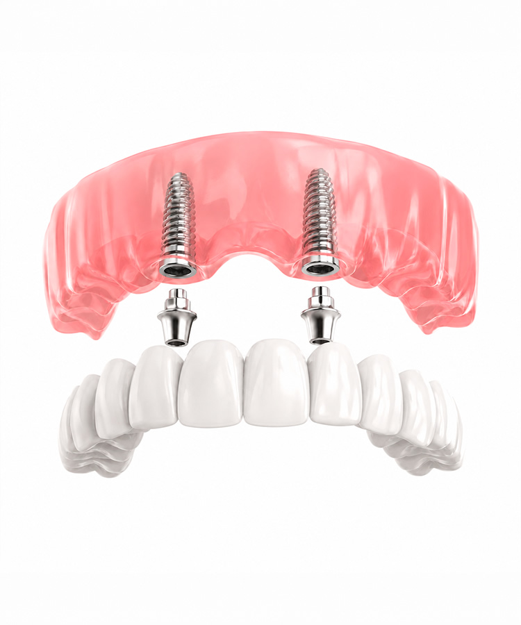 Dental implants