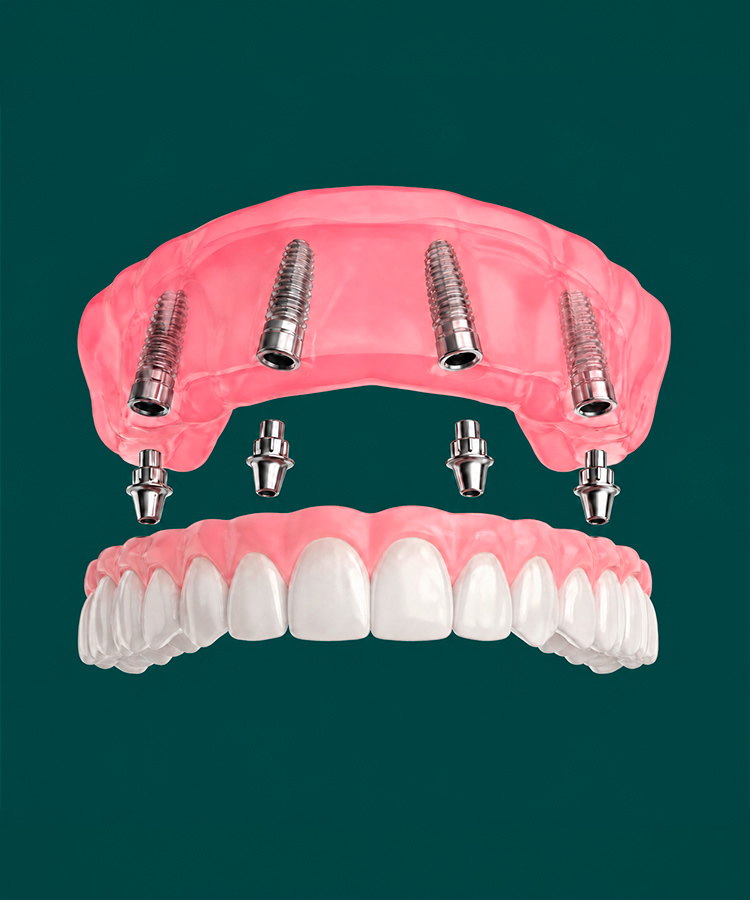 All-on-4 dental implants