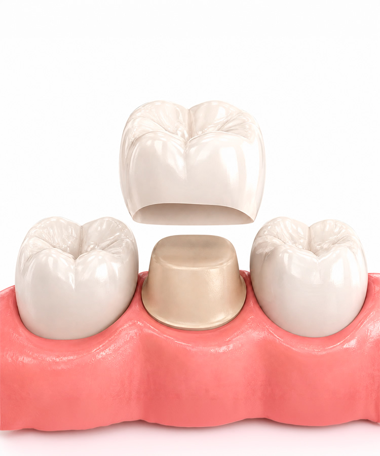 Dental crowns