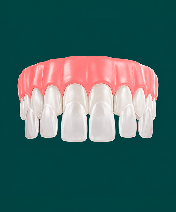 Porcelain veneers