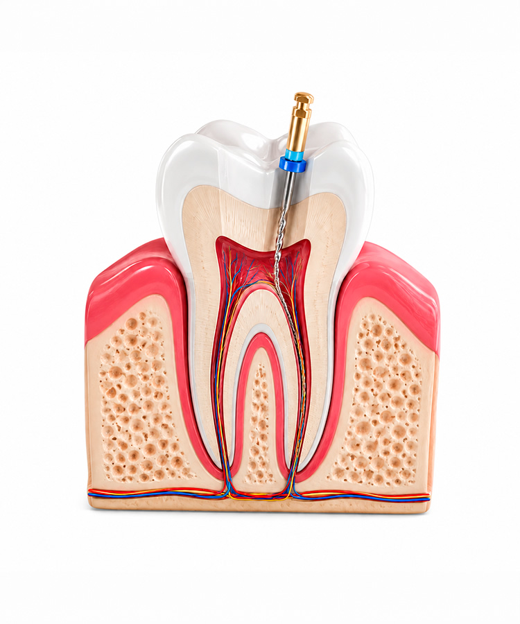 Root canal treatment